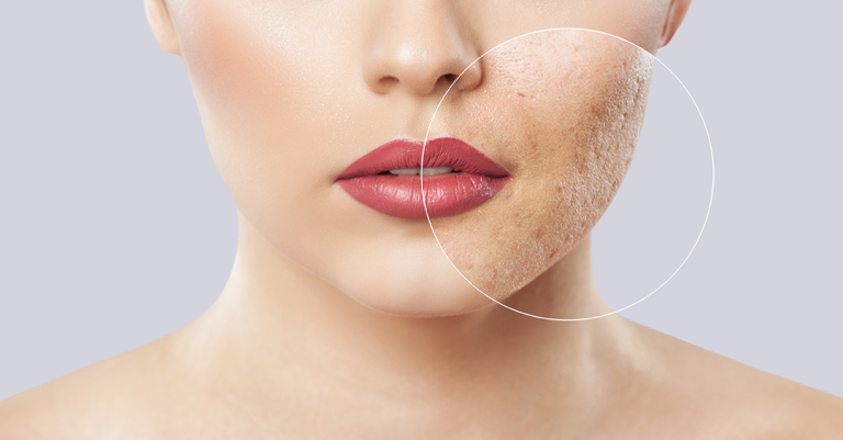 FACING ACNE PROBLEM? HERE ARE 6 SIGNS YOUR BODY NEEDS MORE VITAMIN A