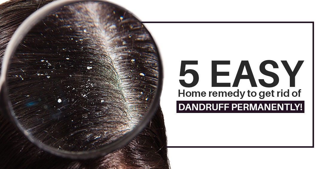 5 Easy Home remedy to get rid of Dandruff permanently!