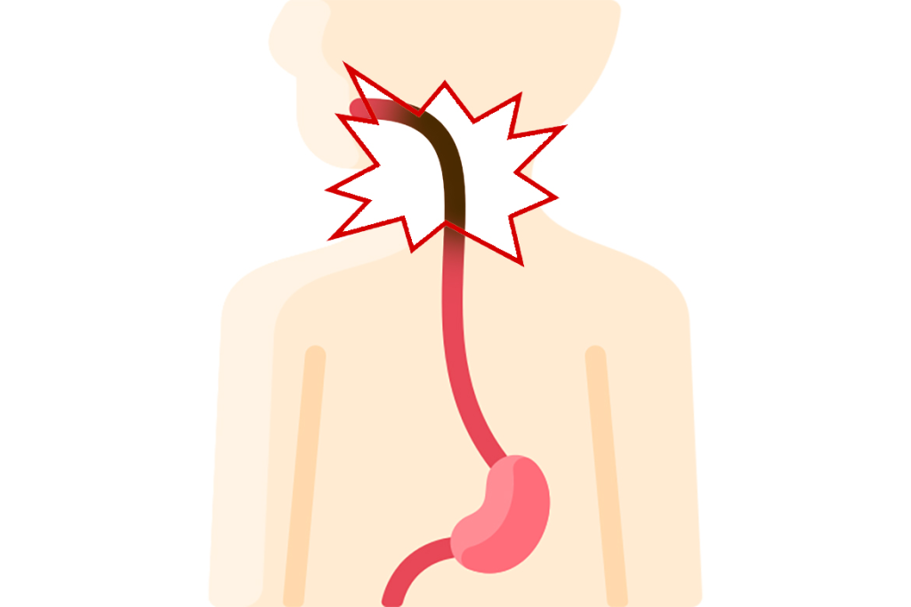 What to Do If You Suspect an Esophageal Injury