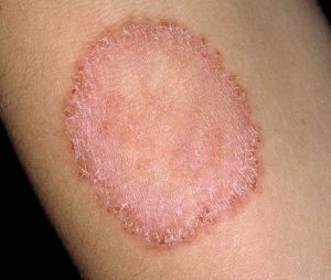 How To Stay Safe From The Ringworm Outbreak In The Gyms?