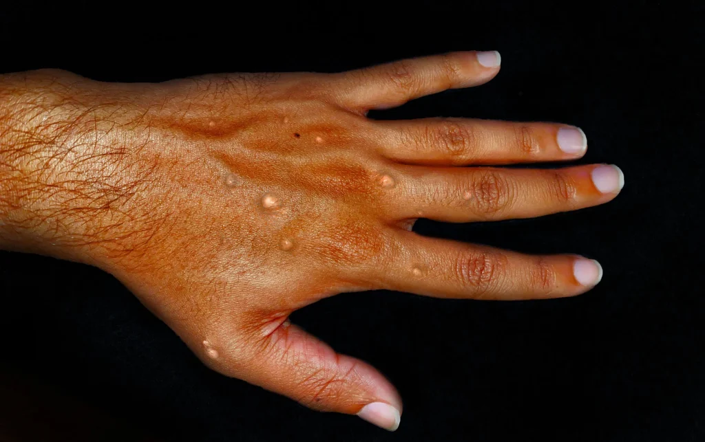 Is Mpox Back Again? New Mpox Outbreak Sparks Global Alarm!